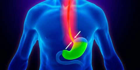 reflujo-gastroesofagico